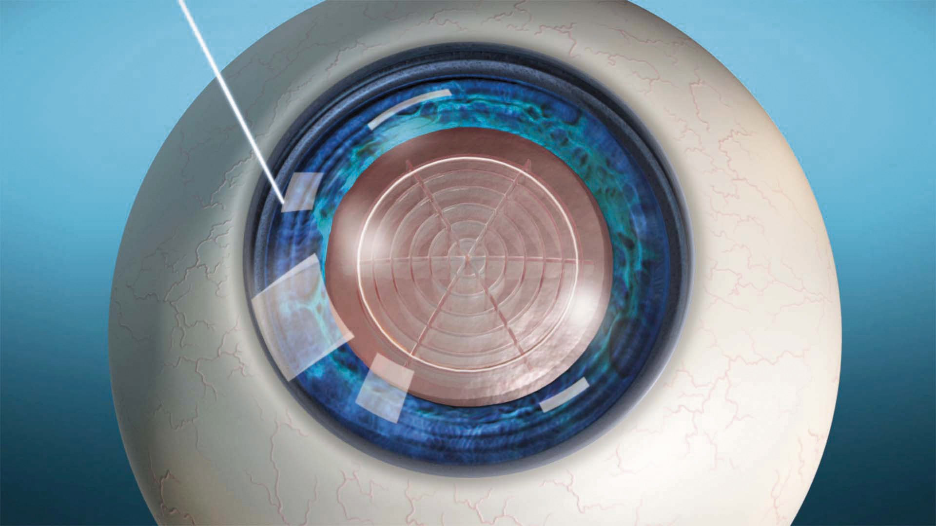 Il Laser esegue le incisioni corneali senza l’uso del bisturi.