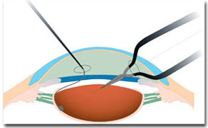 Le tecniche chirurgiche: nucleus holder 