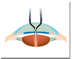Le tecniche chirurgiche: inserimento nucleus holder 